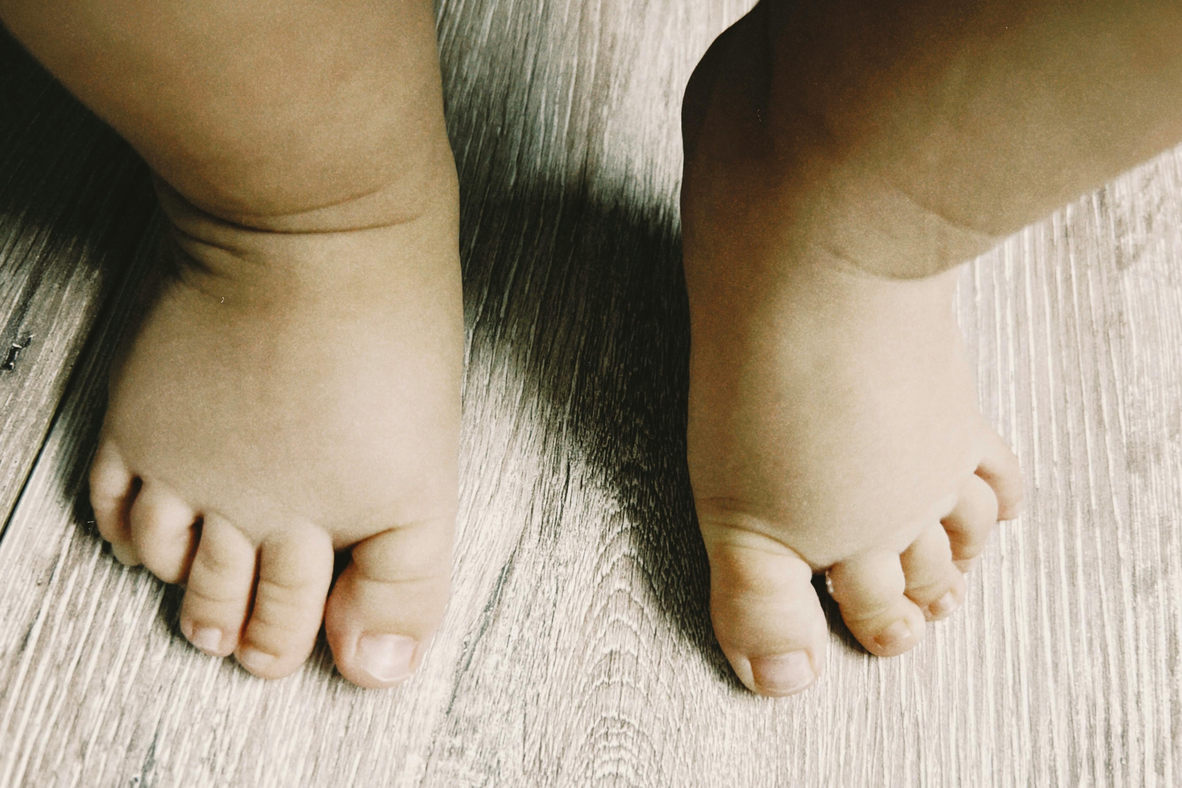 Swollen Feet: Common Causes and When to Act
